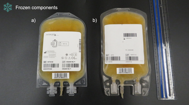 Figure 2. Comparison of apheresis frozen plasma, psoralen-treated, and apheresis plasma not treated when both components are frozen. a) Apheresis frozen plasma, psoralen-treated; b) Apheresis plasma