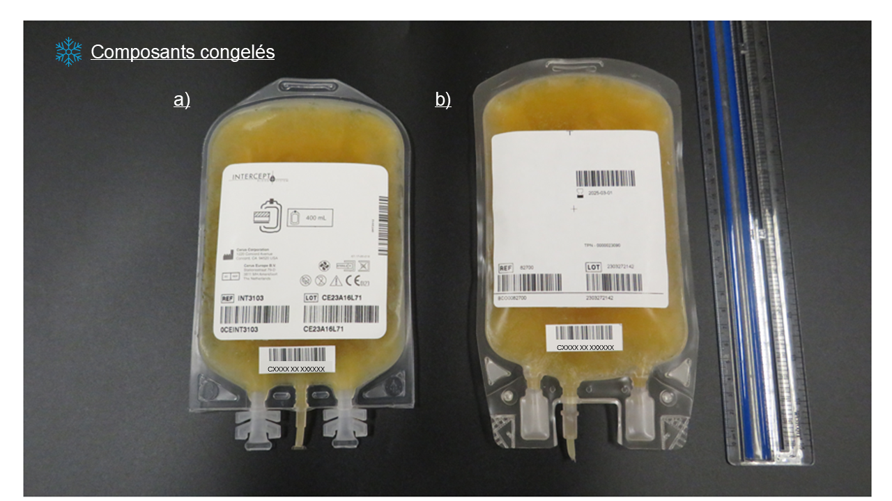 Comparaison entre le plasma-aphérèse congelé traité au psoralène et le plasma-aphérèse non traité lorsque les deux composants sont congelés. a) Plasma-aphérèse congelé traité au psoralène; b) Plasma-aphérèse.