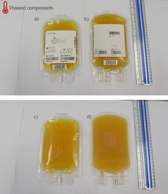 Figure 3. Comparison of apheresis frozen plasma, psoralen-treated and apheresis plasma when both components are thawed. a) Front of apheresis frozen plasma, psoralen-treated unit; b) Front of apheresis plasma unit; c) Back of apheresis frozen plasma, psoralen-treated unit; d) Back of apheresis plasma unit.