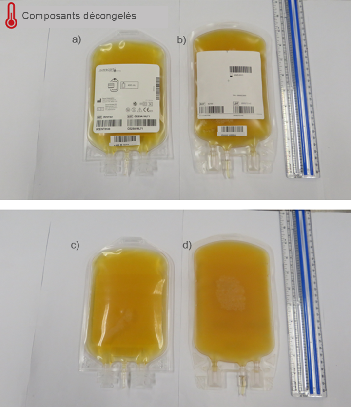Figure 3. Comparaison entre le plasma-aphérèse congelé traité au psoralène et le plasma-aphérèse après décongélation des deux composants. a) Recto d’une unité de plasma-aphérèse congelé traité au psoralène; b) Recto d’une unité de plasma-aphérèse; c) Verso d’une unité de plasma-aphérèse congelé traité au psoralène; d) Verso d’une unité de plasma-aphérèse.