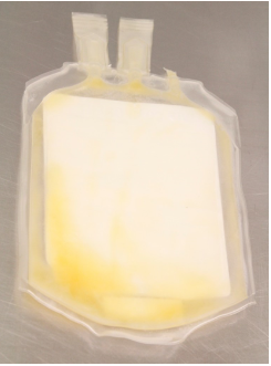 Unit of cryoprecipitate prepared by Canadian Blood Services