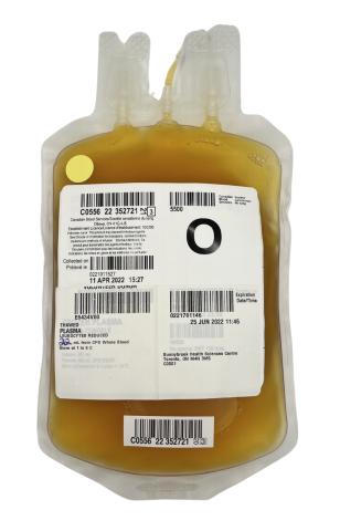 An example of a typical unit of plasma manufactured from whole blood photographed after thawing.