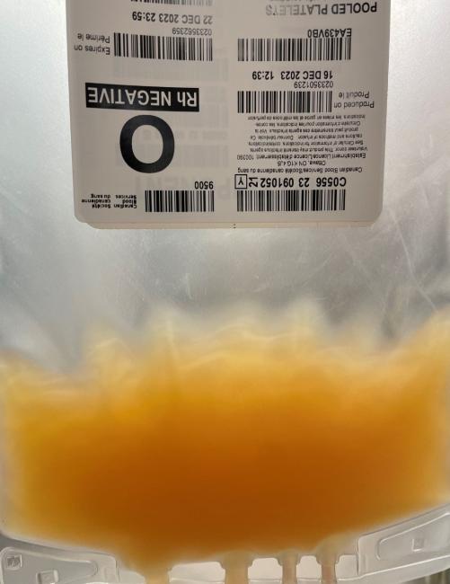 A close up view of a swirl of yellow liquid near the bottom of a platelet unit.