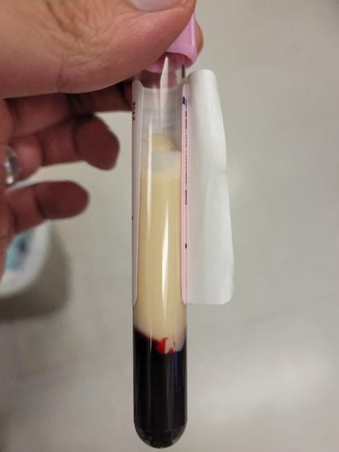 Tube of lipemic red blood cells. Dark red cells are visible at the bottom with a thick, opaque, yellow layer above. 