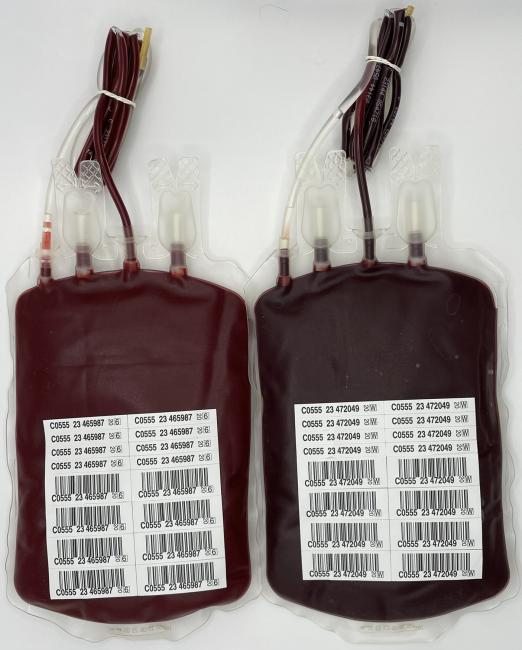 Two units of red blood cells photographed side by side. The unit on the right is slightly darker than the unit on the right.